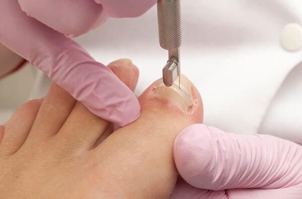 Suffering with an Ingrown Toenail?  Andrea shares how we can help!!