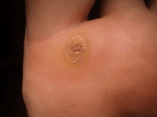 What are Plantar Warts (Verrucae Pedis)?