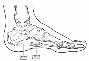 Plantar fibroma and plantar fascia skeletal image
