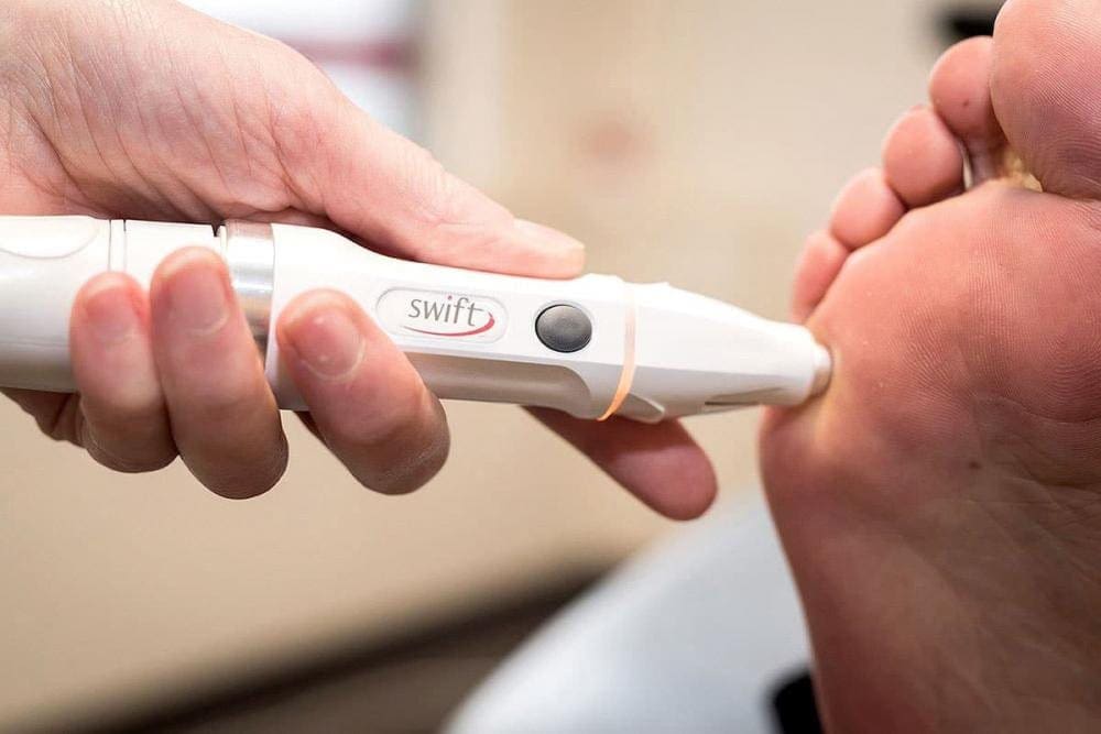 Swift Wart Treatment