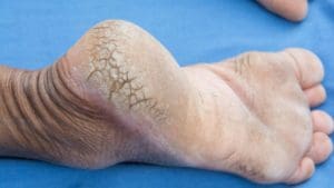 Dry and Cracked Heels