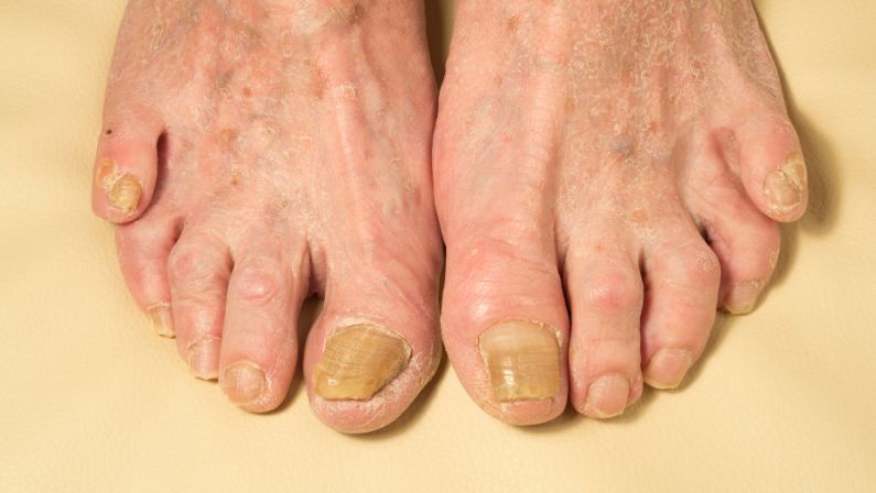 Laser: A Non-Invasive, Efficient Solution for Fungal Nail (Onychomycosis)