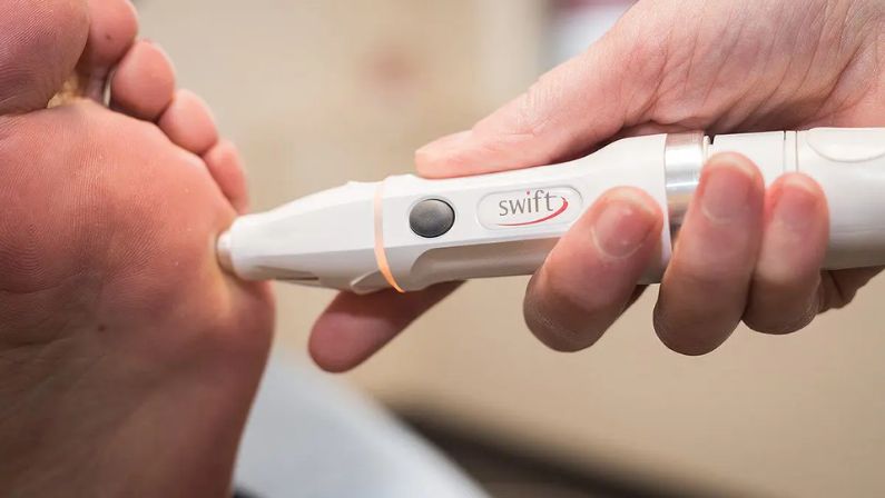 SWIFT Microwave Therapy: A Breakthrough Treatment for Warts at AC Podiatry