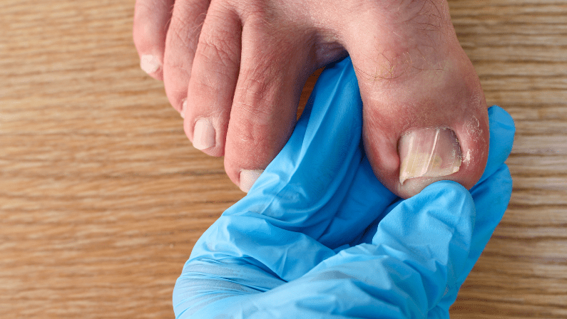 The Ultimate Guide to Understanding, Preventing, and Managing Ingrown Toenails