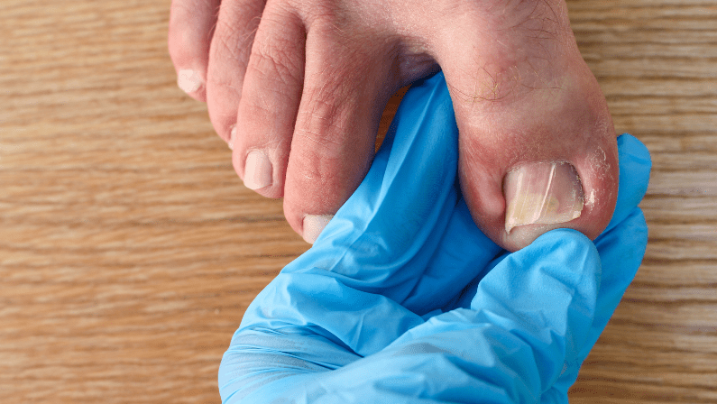 Preventing, and Managing Ingrown Toenails