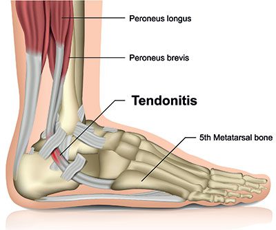 Understanding Peroneal Tendinopathy: Causes, Symptoms, and Treatment Options at AC Podiatry