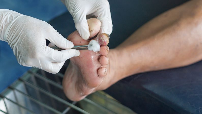 Diabetes and Foot Health: Care from Adelaide Podiatrists